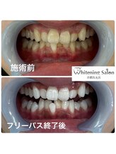 ホワイトニングサロン 京都烏丸店/ホワイトニング施術例