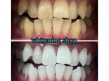 ホワイトニングショップ 池田店/