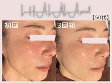 美シェリ(美Cheri)/ララピールビフォーアフター