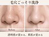 【毛穴徹底ケア】ハイドロクレンズ水素毛穴洗浄☆鼻の毛穴が黒ずむ前に