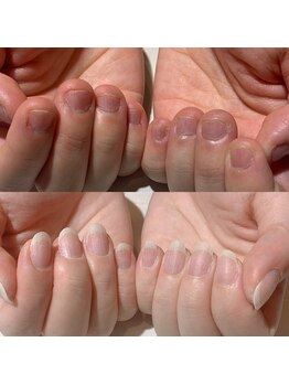 アティックネイルアトリエ(attic nail atelier)/深爪改善コース