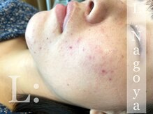 リベル 名古屋(Lebelle:)/ハーブピーリング　名古屋