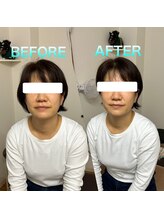 代々木美容鍼灸サロン さくら/美容鍼　before　after