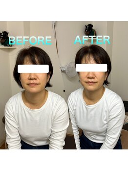 代々木美容鍼灸サロン さくら/美容鍼　before　after