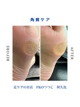 ピーアンドオー(P&O)/角質ケア