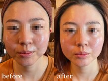 エピリス(Epiliss)/小顔ビフォーアフター