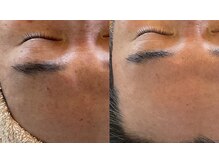 リノアンド(Lino&)/毛穴対策、肌質改善