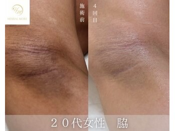 ウルワシ(Uruwashi)/ハーバルモアハーブピーリング