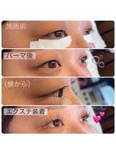 アイキャンディ(iCandy)/エクパー同時施術