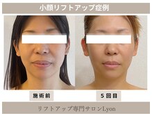 リヨン(Lyon)/（40代）リフトアップ・小顔効果