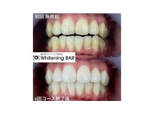 ホワイトニングバー 心斎橋オーパ店/効果が目に見えるホワイトニング