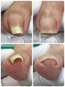 【2回目以降】《巻き爪・陥入爪》の補正 (両足2ヶ所)【¥11,000】[フットケア]