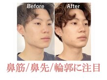 ラプリ 仙台店(Raplit stella)/隆鼻+輪郭40分 10回