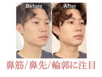 ラプリ 仙台店(Raplit stella)/隆鼻+輪郭40分 10回