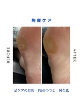 ピーアンドオー(P&O)/角質ケア