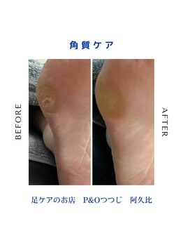 ピーアンドオー(P&O)/角質ケア