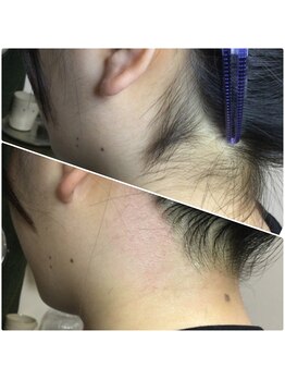 カルム(Calme)/うなじ脱毛