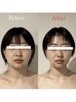 ハイコガオ 中崎町店(HIKOGAO)/小顔矯正