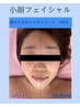 《むくみ・たるみ改善》小顔フェイシャル60分(美容液導入付き)¥6,980