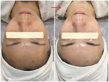 オージャス(OJAS)/40代のお客様/シミ.しわ.毛穴