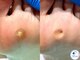 プラスワンフット 本厚木(+1 Foot)の写真/痛みの原因にアプローチする魚の目ケア。歩くのがラクになる、その一歩をお手伝いします。巻き爪/魚の目