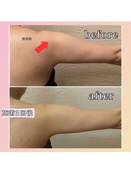 プリマジュール/【ブライダルの方必見】二の腕