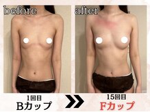 プリマ(prima)/バストアップ症例
