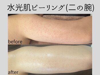 マーベル(MaaBelle)/水光肌ピーリング(二の腕)