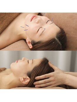 エヌ(N)/【電気美容鍼×頭皮鍼】頭痛にも