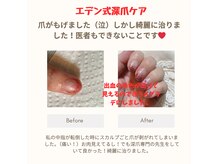 ネイルエデン サロン(NAIL EDEN SALON)の雰囲気（事故やアクシデントで爪が潰れた、失った方ご相談ください）
