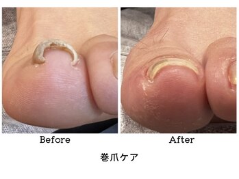 アンベリール(embellir.)/巻爪ケア