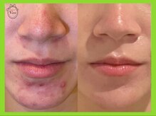 ハーブピーリング 名古屋/肌トラブル改善！