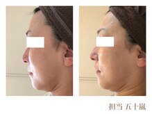 クロエクロウ(chloe'crow)/【施術結果】コルギ