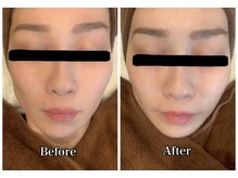 ブランシュール/エンビロン塗るヒアルロン酸注入