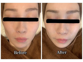 ブランシュール/エンビロン塗るヒアルロン酸注入