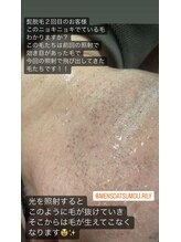 リリー(RILY)/【髭脱毛】