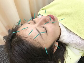 北越谷みんなの鍼灸整骨院/小顔になりたい方にもおすすめ♪