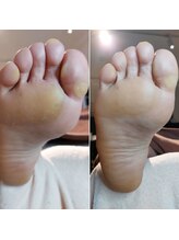 爪切り屋 足楽/足裏の硬いヤツ◆足底胼胝