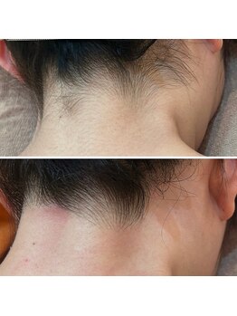 グルーミー(gloomy)/まとめ髪！怖くない♪うなじ脱毛