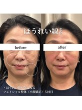 フェアリーフェイス 南森町店(Fairy Face)/南森町/小顔矯正５回目