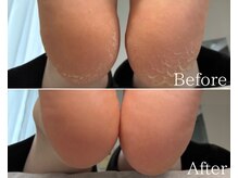 カシェット 広島店(Cachette)/30代女性☆足裏角質ケア60分