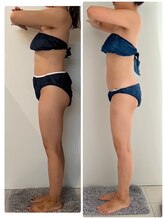 エムプリュ 心斎橋店(M.plus)/全身ハイパーナイフ5回目！