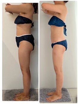 エムプリュ 心斎橋店(M.plus)/全身ハイパーナイフ5回目！