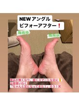 フィートウォーマー(Feet Warmer)/足つぼビフォーアフター4
