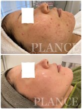 プランス 渋谷(PLANCE)/毛穴/ハーブ/ニキビケア