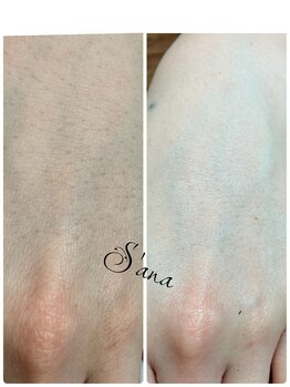 サナ 久が原 千鳥町(S’ana)/ハーブピーリング