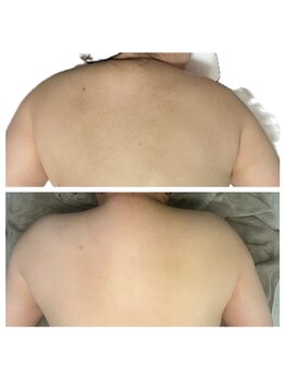 美温(mion)/肩の厚みがとれました