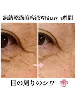 ケンビラク(Kenbiraku 健美楽)/目の周りのシワ　1週間