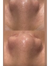 プラチナムブロウ 新潟(PLATINUM BROW)/毛穴洗浄で毛穴レス肌に！