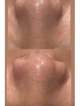 プラチナムブロウ 新潟(PLATINUM BROW)/毛穴洗浄で毛穴レス肌に！